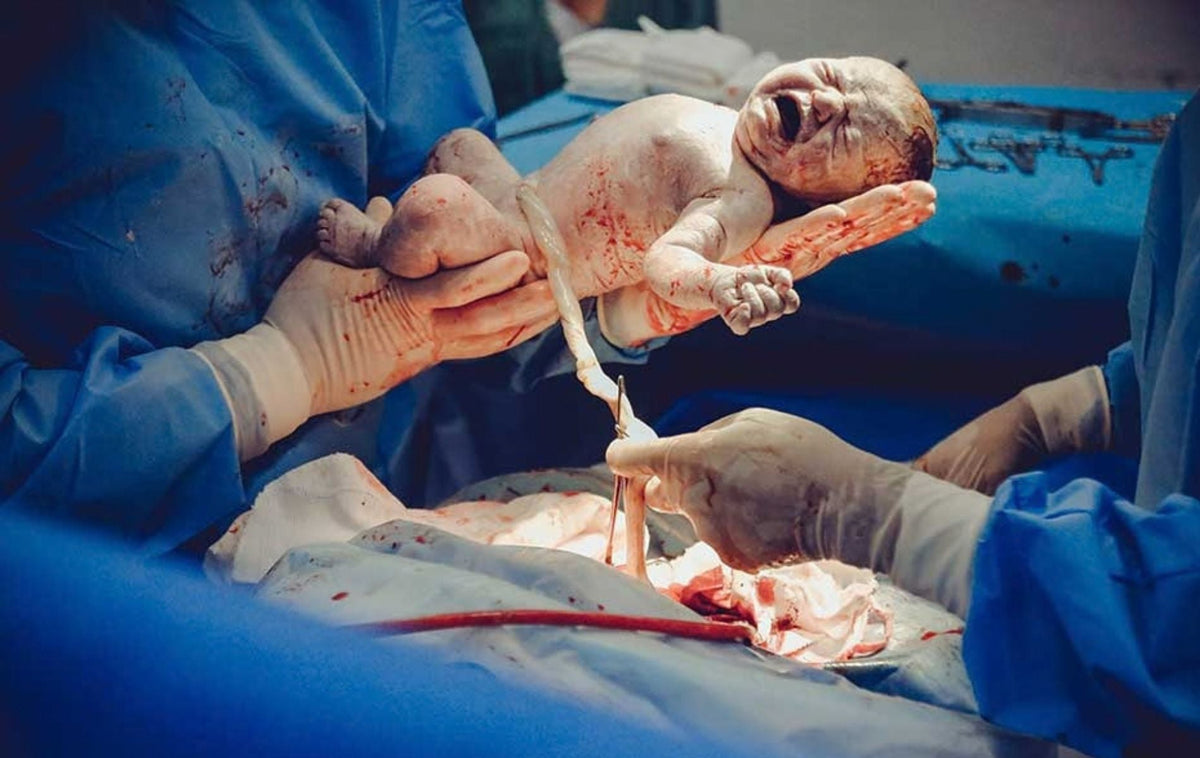 C-Section Hospital Bag Ireland: What Changes for a Planned Caesarean?